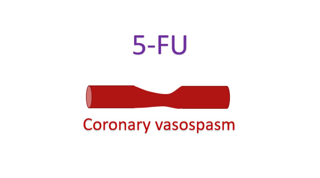Coronary vasospasm with 5-FU (Symbolic image)
