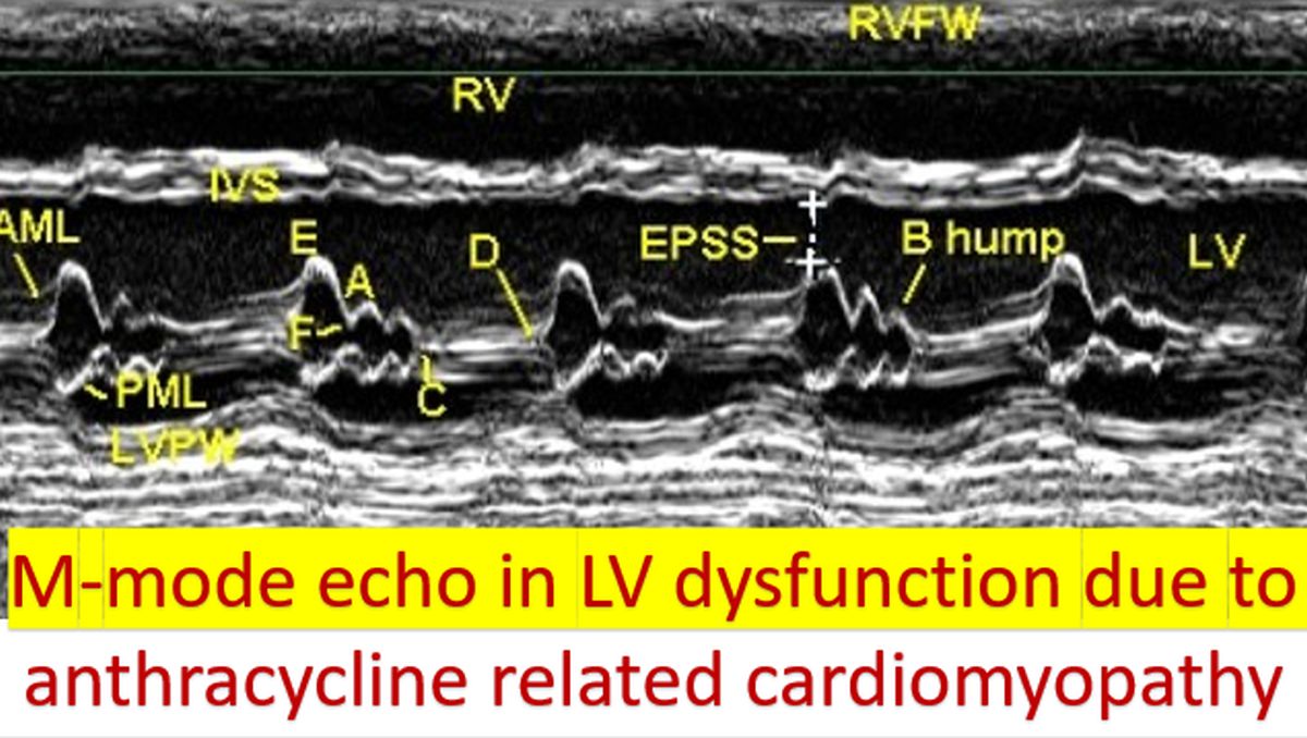 M-mode echo in LV dysfunction due to anthracycline related cardiomyopathy