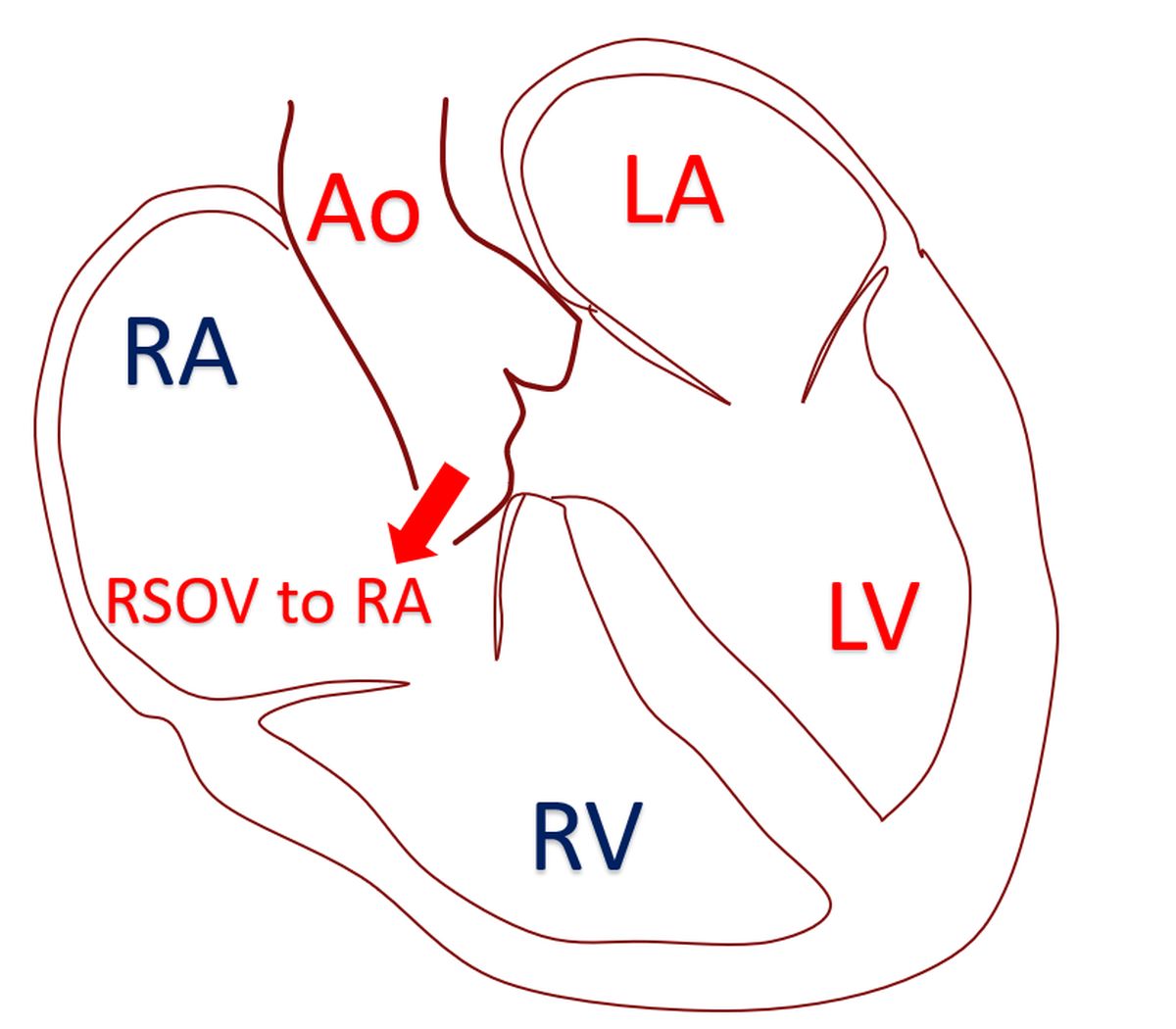 Rupture of sinus of Valsalva aneurysm (RSOV) to right atrium