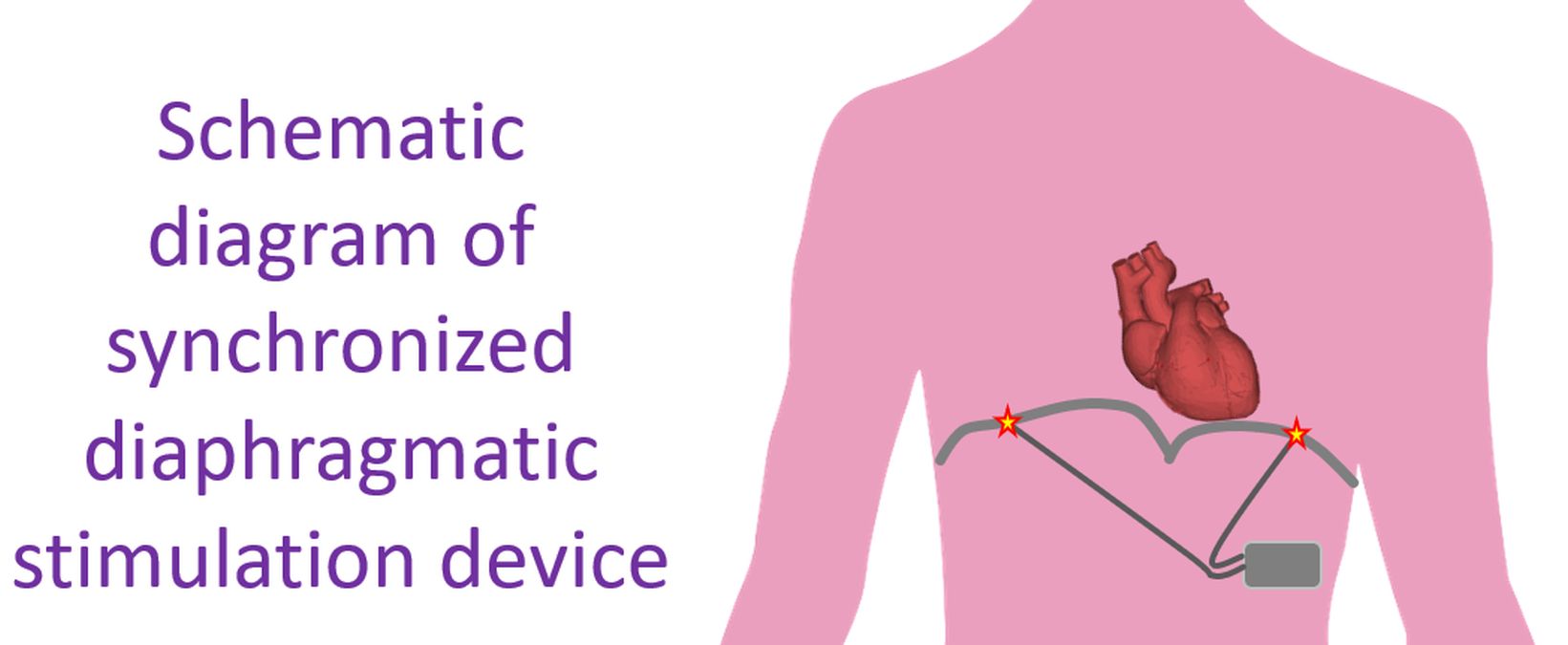 Schematic diagram of synchronized diaphragmatic stimulation device