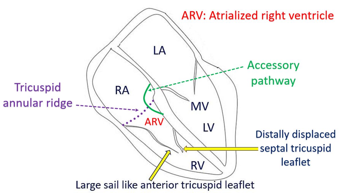 Tricuspid annular ridge and accessory pathway in Ebstein's anomaly
