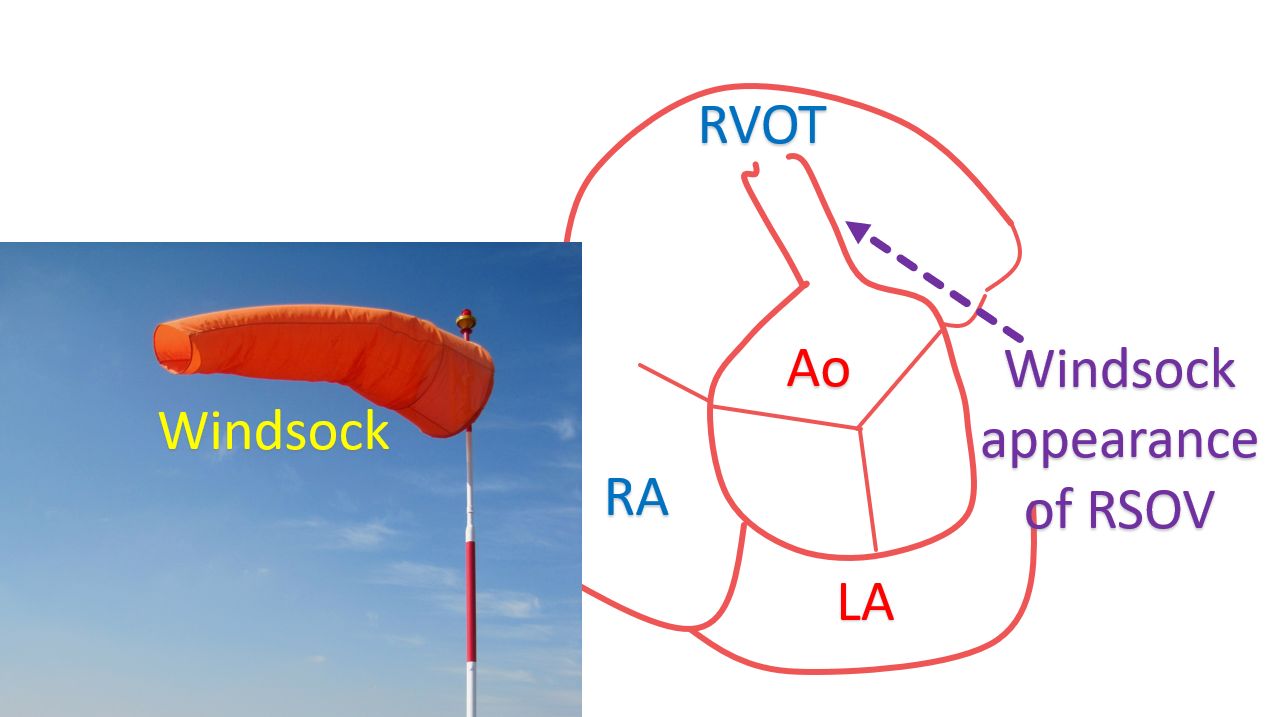Windsock appearance of RSOV on echocardiogram