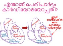 എന്താണ് പെരിപാർട്ടം കാർഡിയോമയോപ്പതി