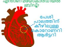എന്താണ് മയോകാർഡിയൽ ബ്രിഡ്ജ്