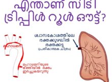 എന്താണ് സിടി ട്രിപ്പിൾ റൂൾ ഔട്ട്