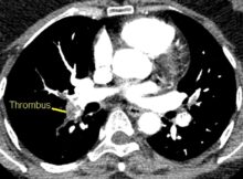 Thrombus in pulmonary artery