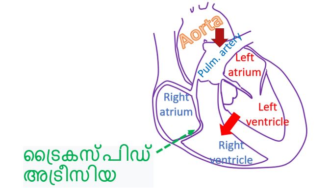 ട്രൈകസ്പിഡ് അട്രീസിയ