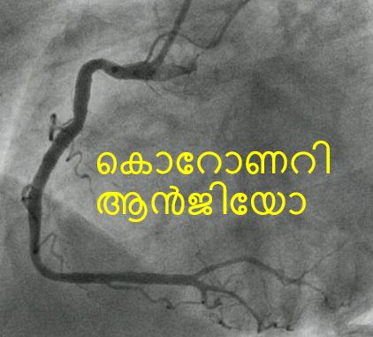 കൊറോണറി ആൻജിയോ