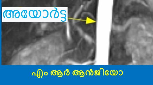 എം ആർ ആൻജിയോ