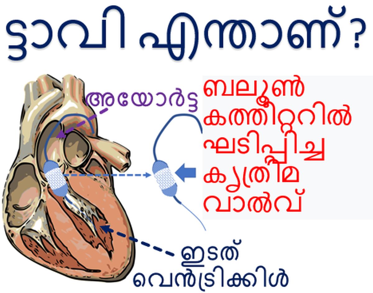 ട്ടാവി എന്താണ്
