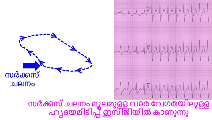 സർക്കസ് ചലനം മൂലമുള്ള വരെ വേഗതയിലുള്ള ഹൃദയമിടിപ്പ് ഇസിജിയിൽ കാണുന്നു
