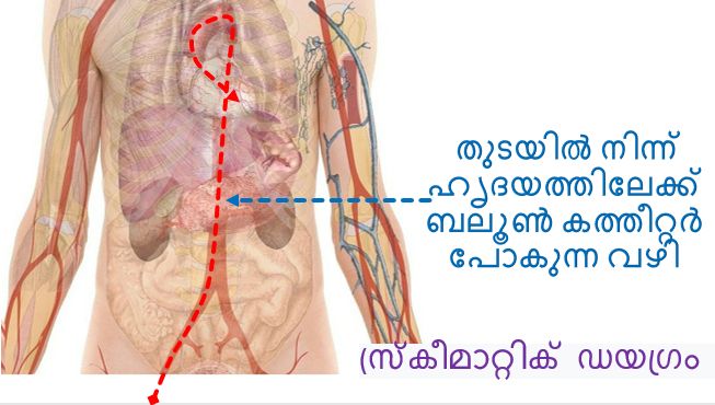 തുടയിൽ നിന്ന് ഹൃദയത്തിലേക്ക് ബലൂൺ കത്തീറ്റർ പോകുന്ന വഴി