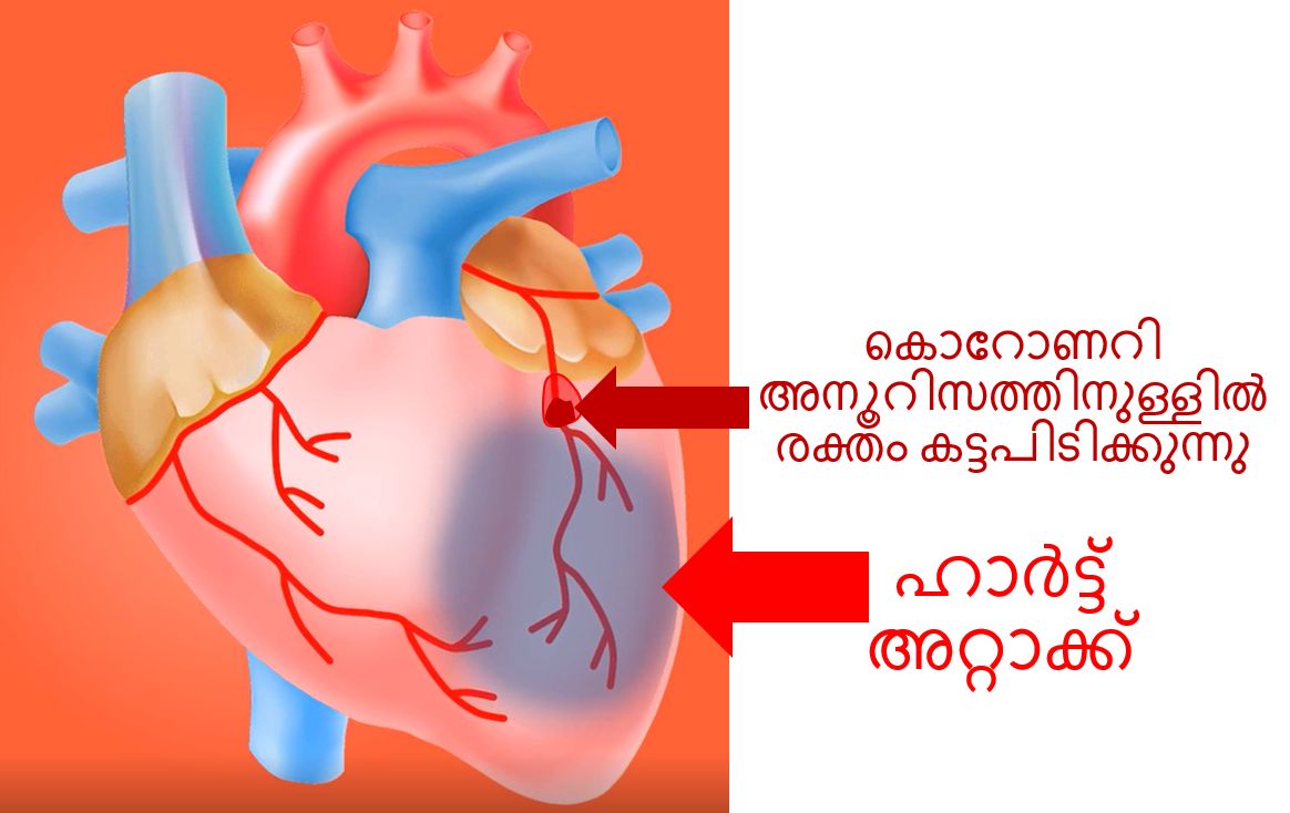 കാവസാക്കി രോഗത്തിൽ ഹൃദയാഘാതം