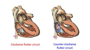 Atrial flutter - All About Cardiovascular System and Disorders