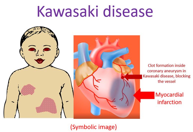 Manifestations of Kawasaki disease