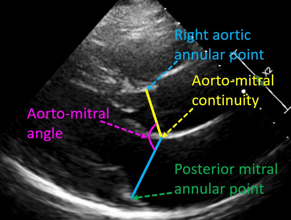 Measurement of aorto-mitral angle from PLAX view