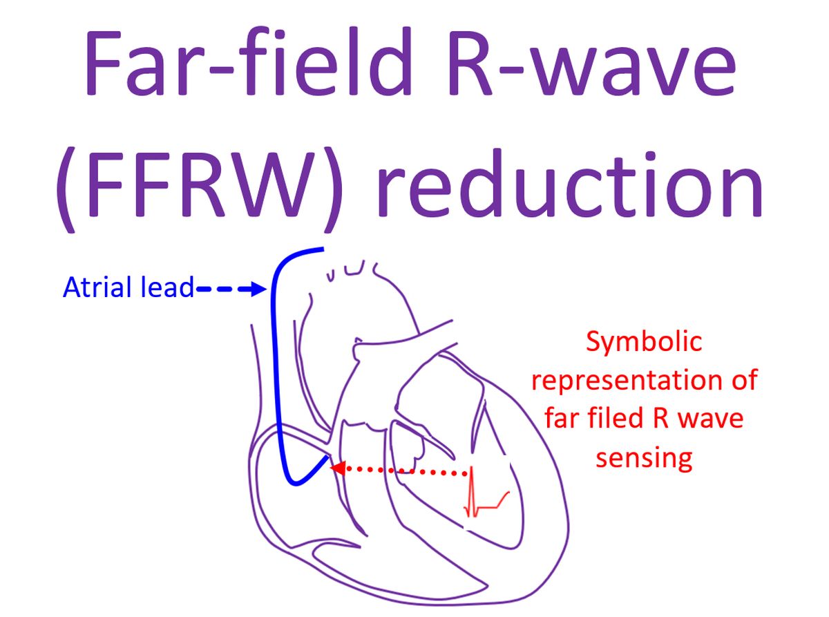 Symbolic representation of far field R wave sensing