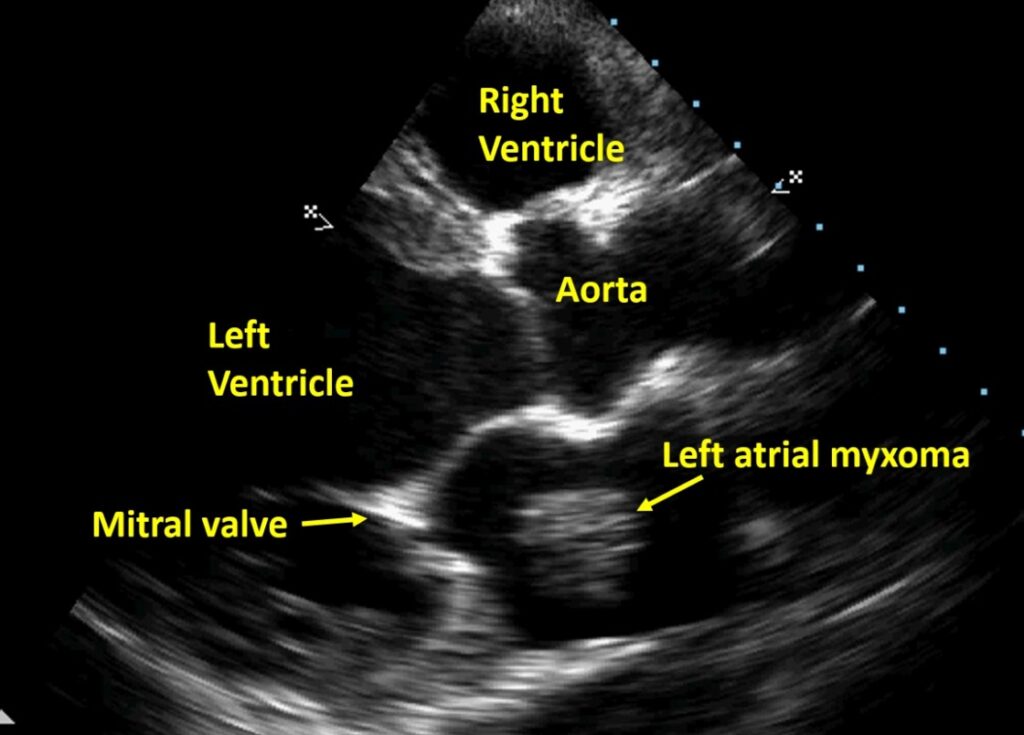 Cardiac tumours – All About Cardiovascular System and Disorders