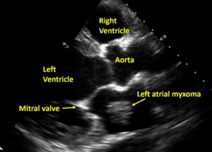 Left atrial myxoma on echocardiogram