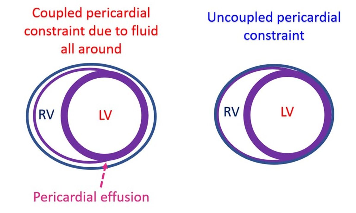 Coupled and uncoupled pericardial constraint