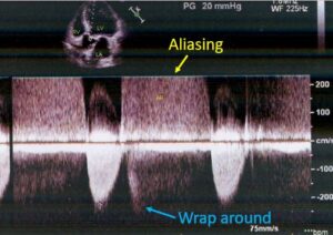 What Is The Difference Between Pulsed Wave And Continuous Wave Doppler