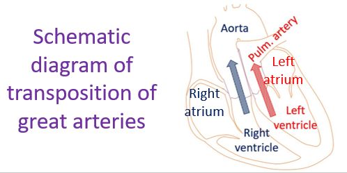 Schematic diagram of transposition of great arteries