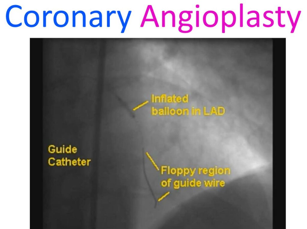 history of coronary angioplasty icd 10