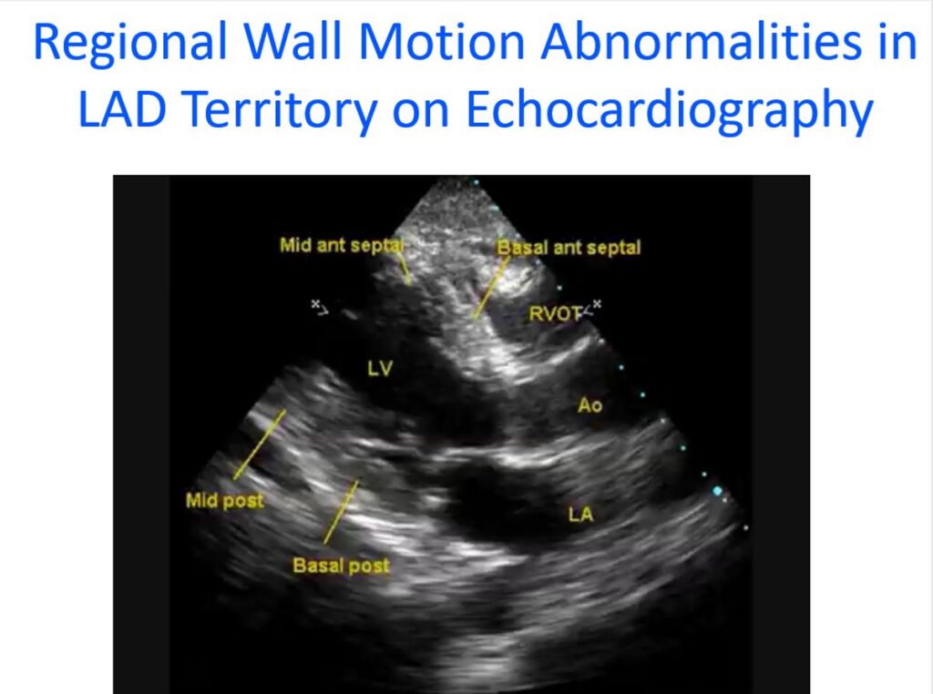 Regional wall motion abnormalities in coronary artery disease – All About  Cardiovascular System and Disorders
