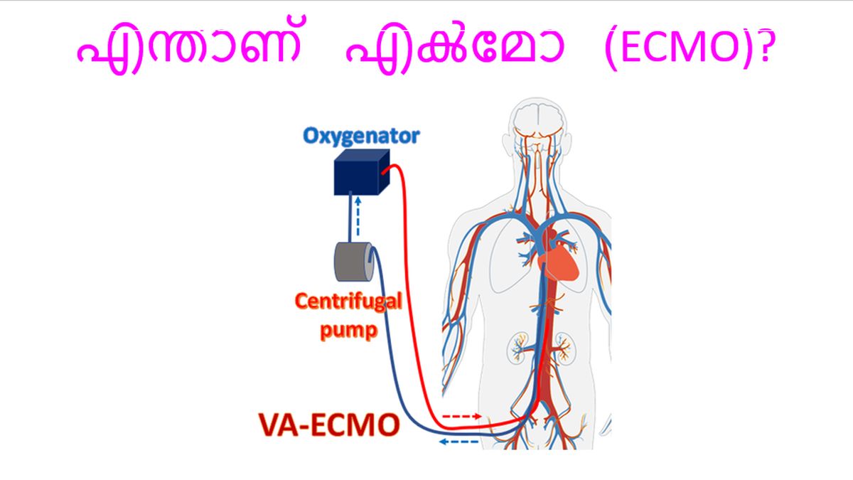 എന്താണ് എൿമോ (ECMO)