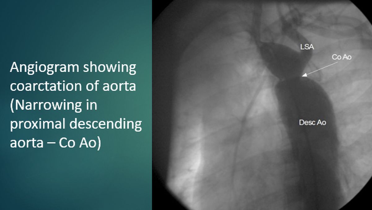 Angiogram showing coarctation of aorta (Narrowing in proximal descending aorta – Co Ao)