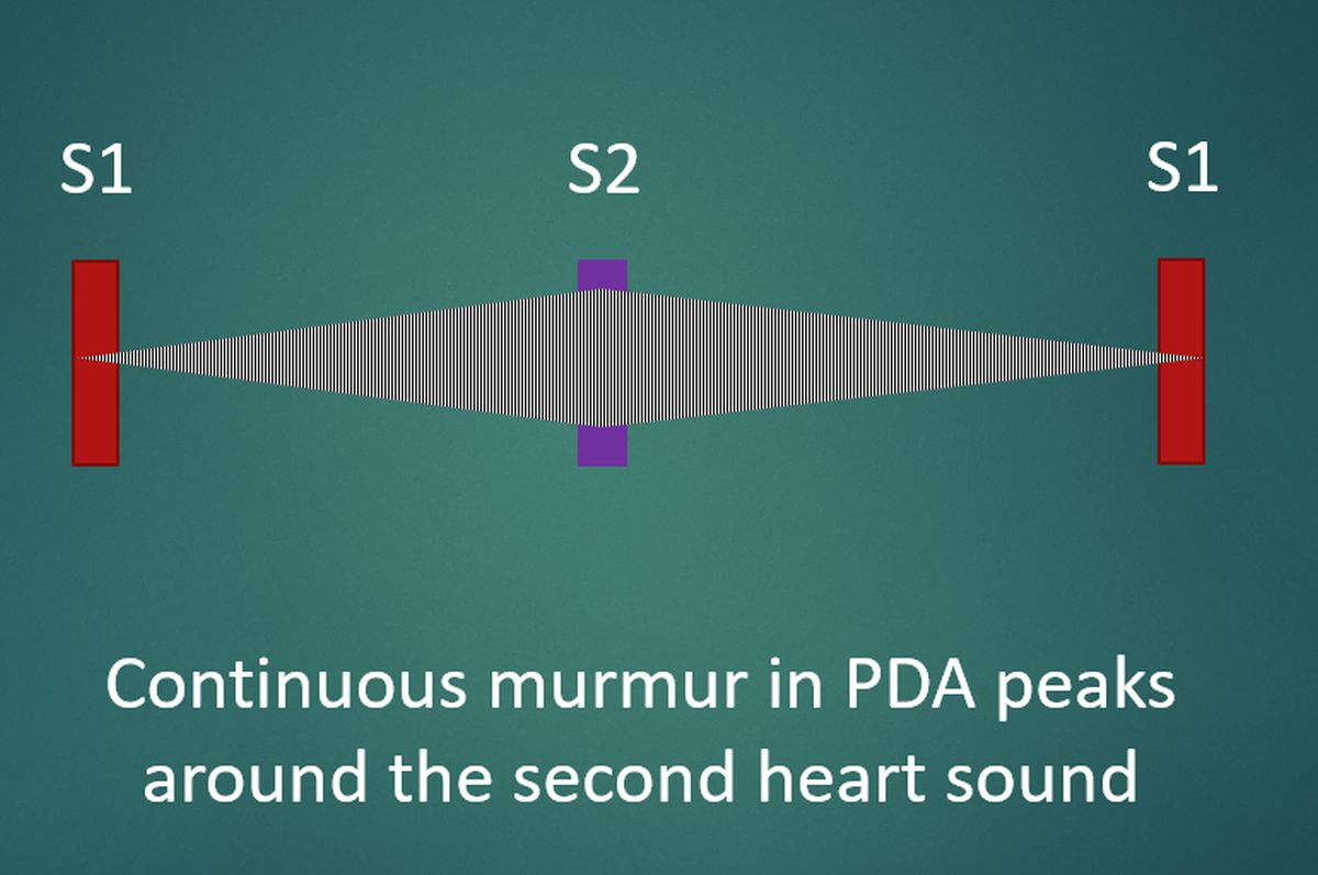 Continuous murmur in PDA peaks around the second heart sound