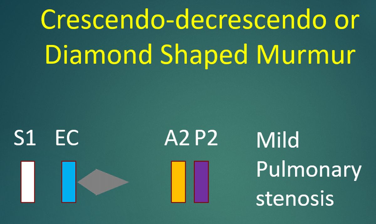 Crescendo-decrescendo or Diamond Shaped Murmur