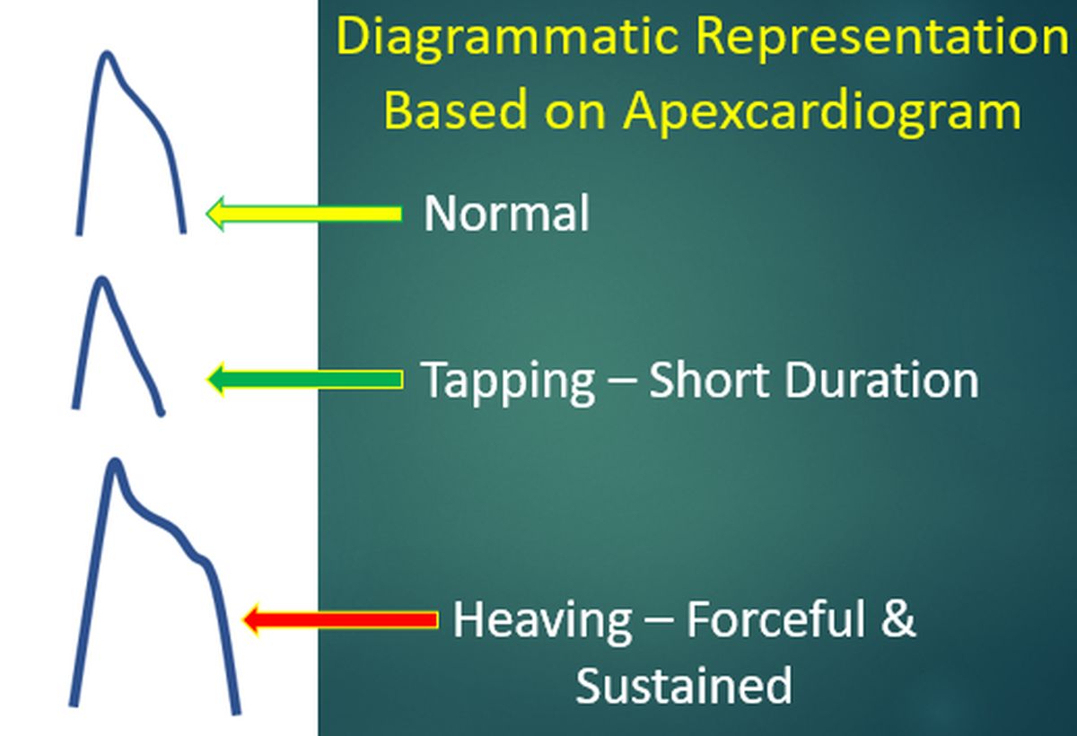 Diagrammatic Representation Based on Apexcardiogram