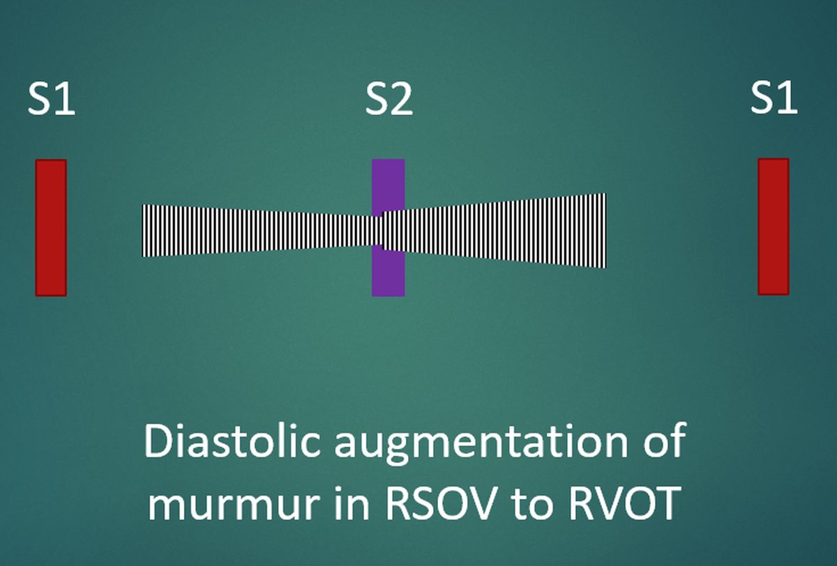 Diastolic augmentation of murmur in RSOV to RVOT
