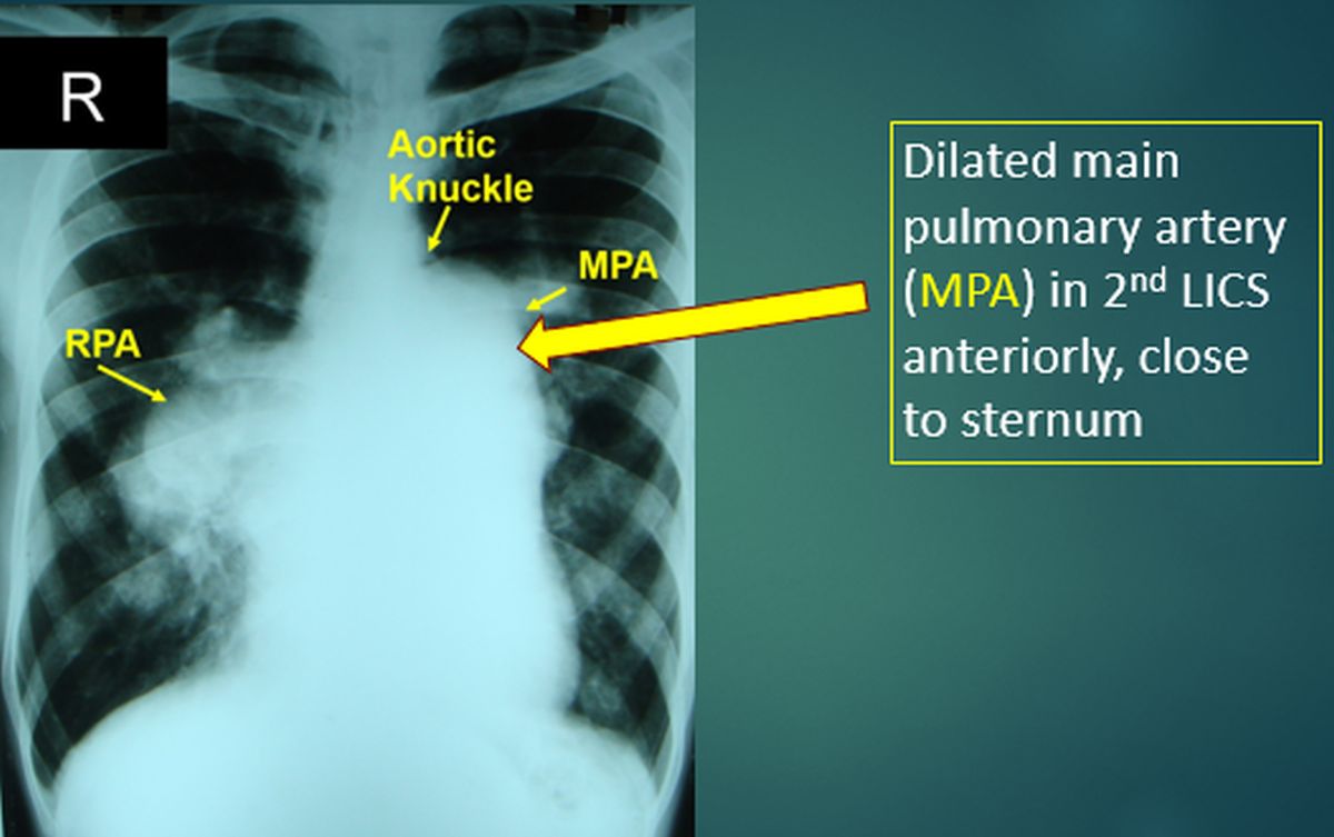 Dilated main pulmonary artery (MPA) in 2nd LICS anteriorly, close to sternum