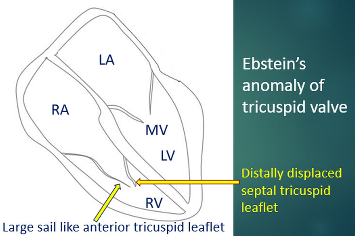 Ebstein’s anomaly of tricuspid valve