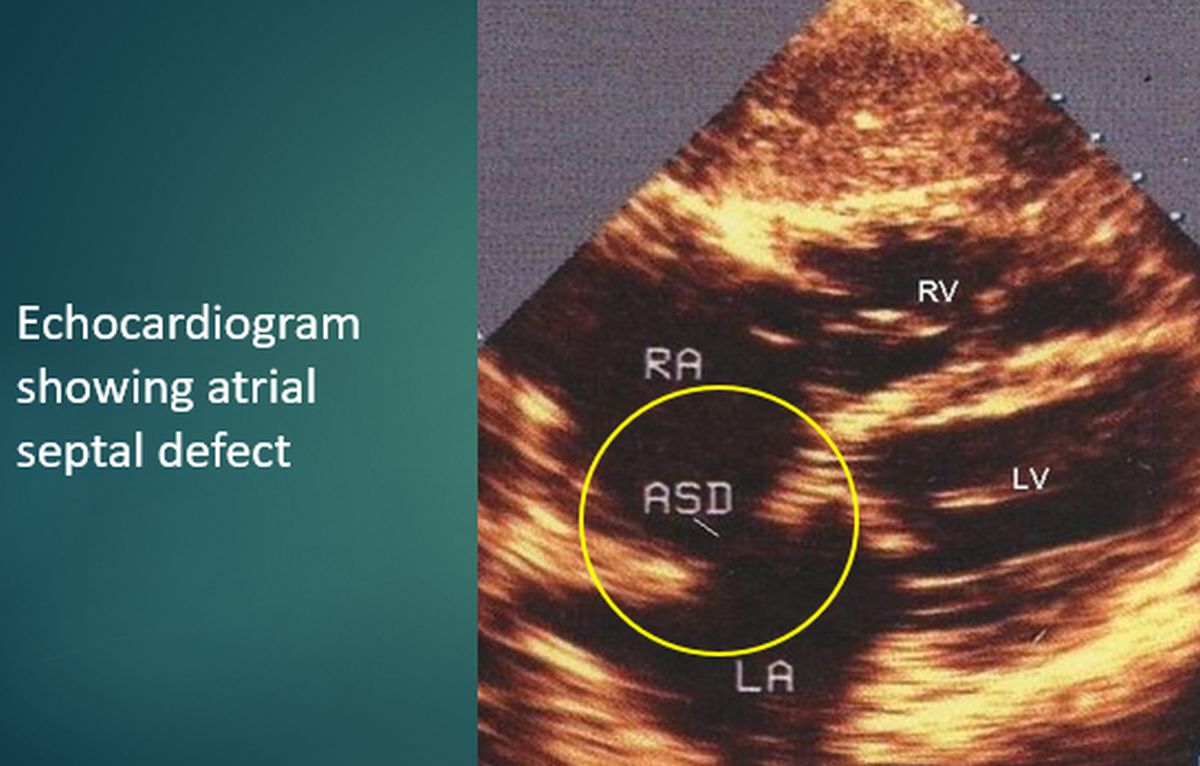 Echocardiogram showing atrial septal defect