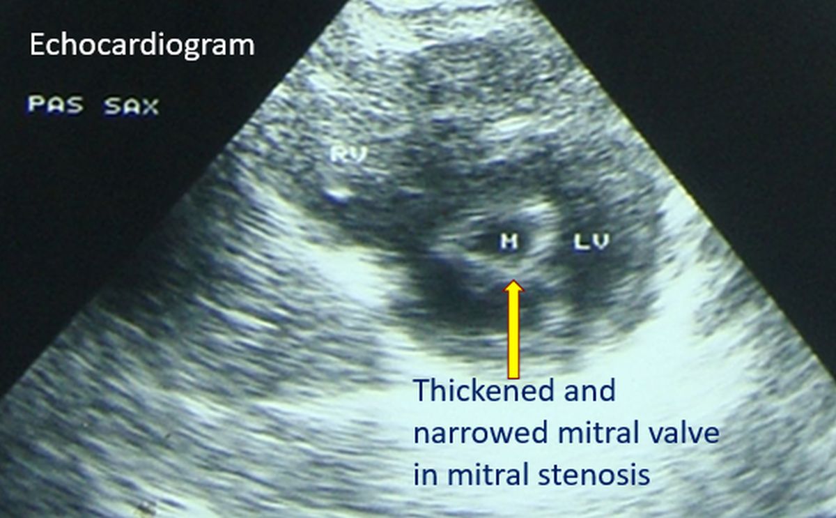 Echocardiogram showing hickened and narrowed mitral valve in mitral stenosis