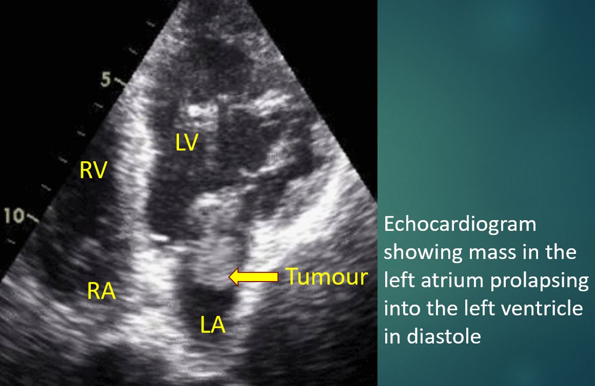 Echocardiogram showing mass in the left atrium prolapsing into the left ventricle in diastole