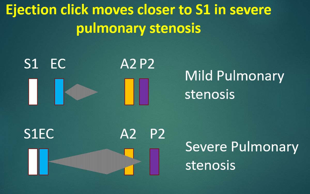 Ejection click moves closer to S1 in severe pulmonary stenosis