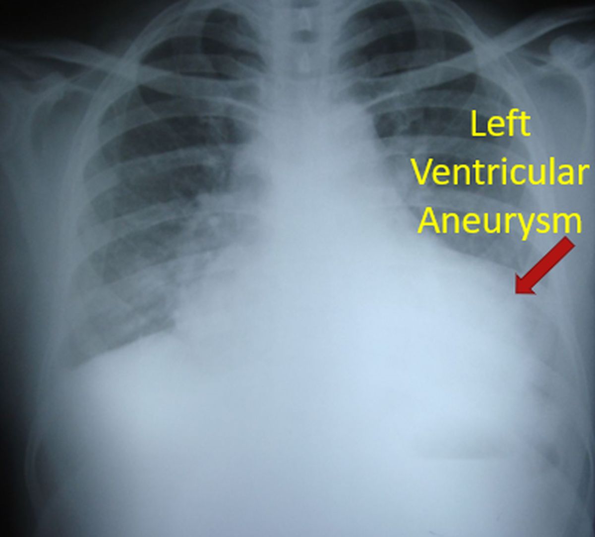 Left Ventricular Aneurysm
