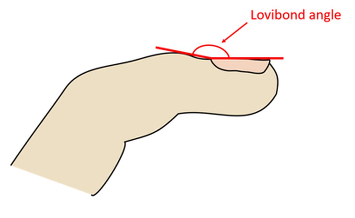 Lovibond angle and clubbing of fingers