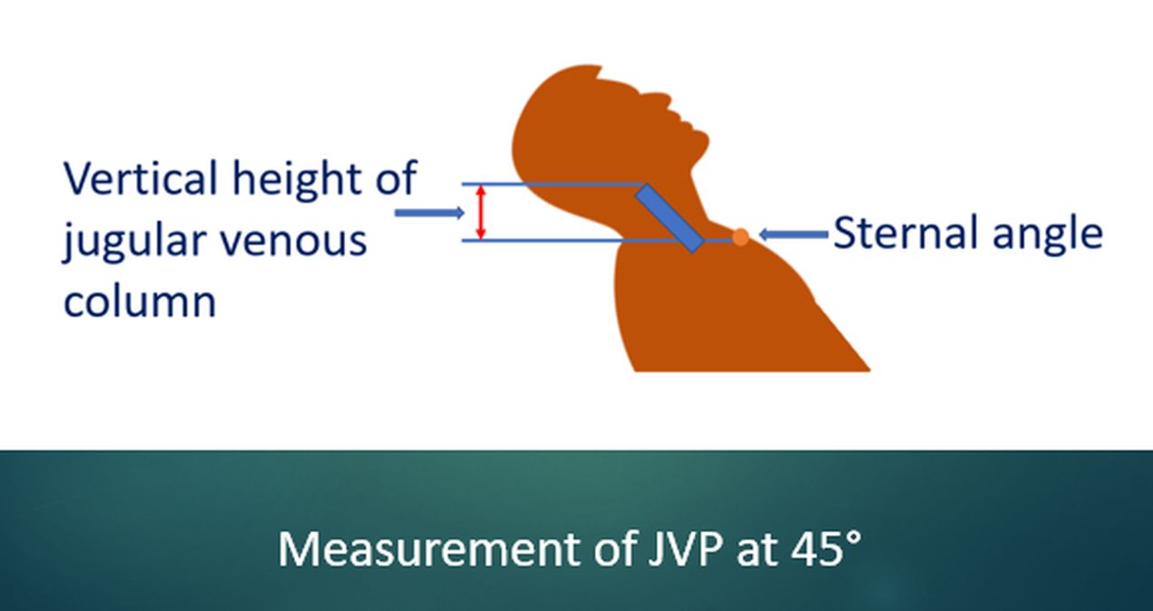 Measurement of JVP at 45°