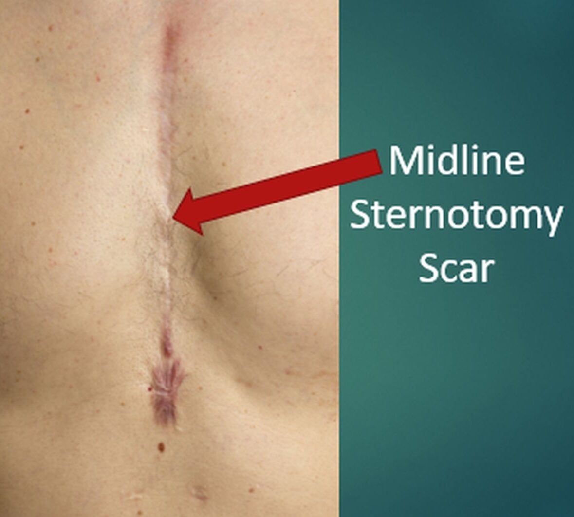 Midline Sternotomy Scar
