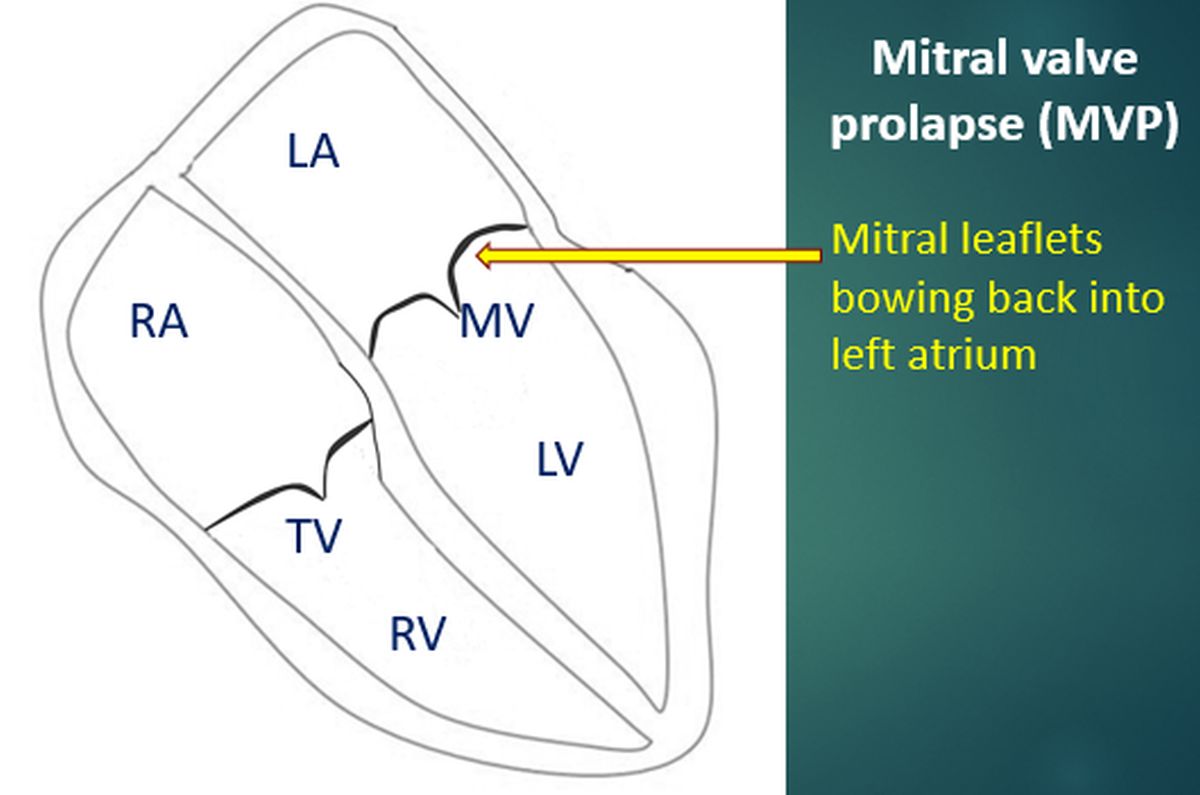 Mitral valve prolapse (MVP)