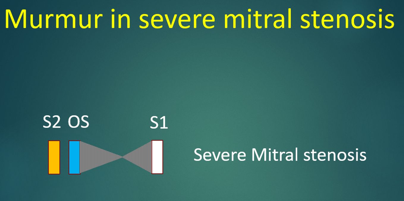 Murmur in severe mitral stenosis