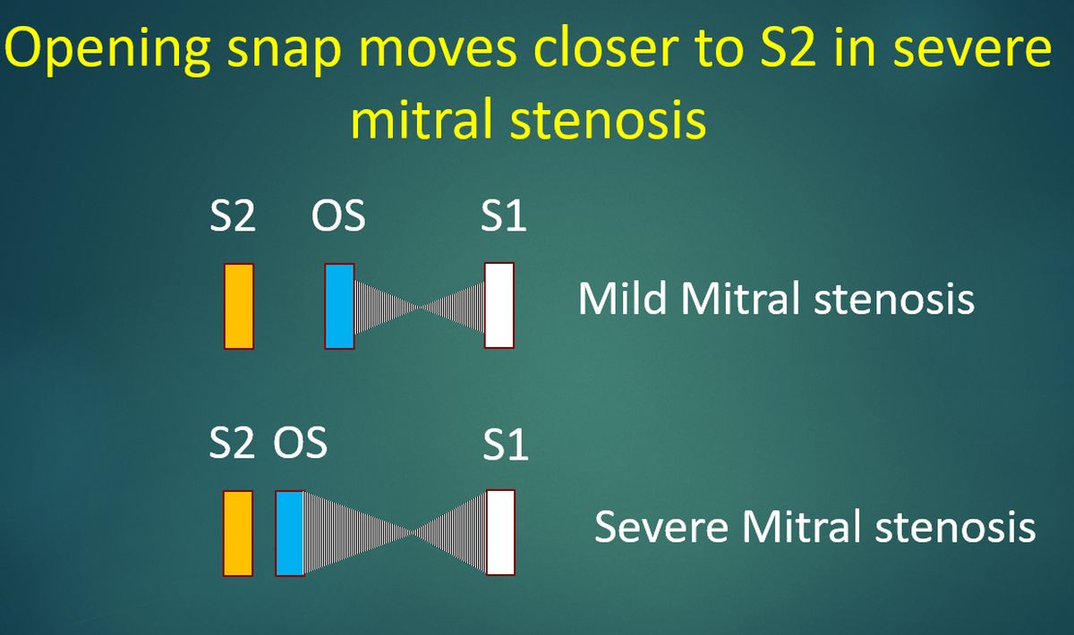 Opening snap moves closer to S2 in severe mitral stenosis