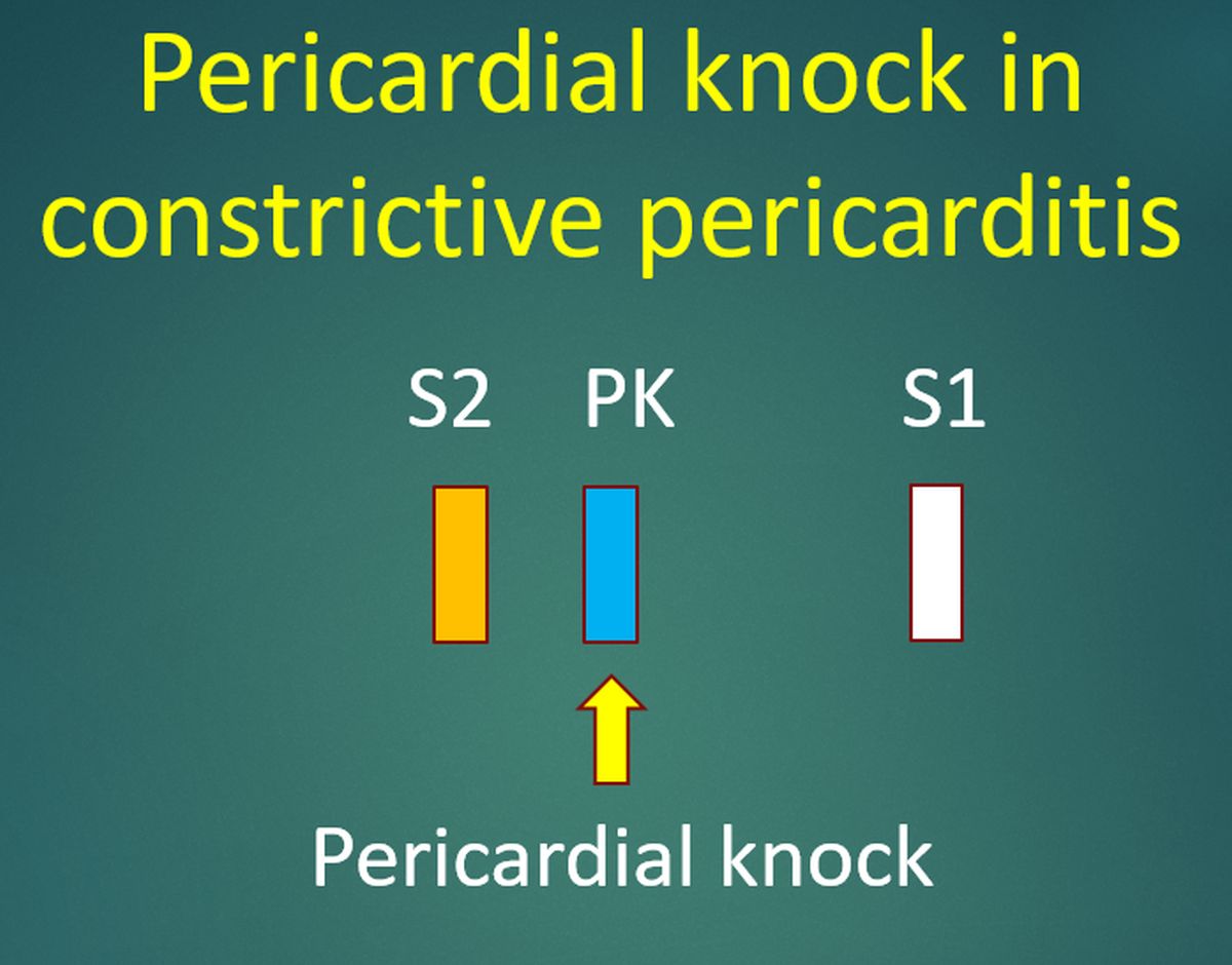 Pericardial knock in constrictive pericarditis