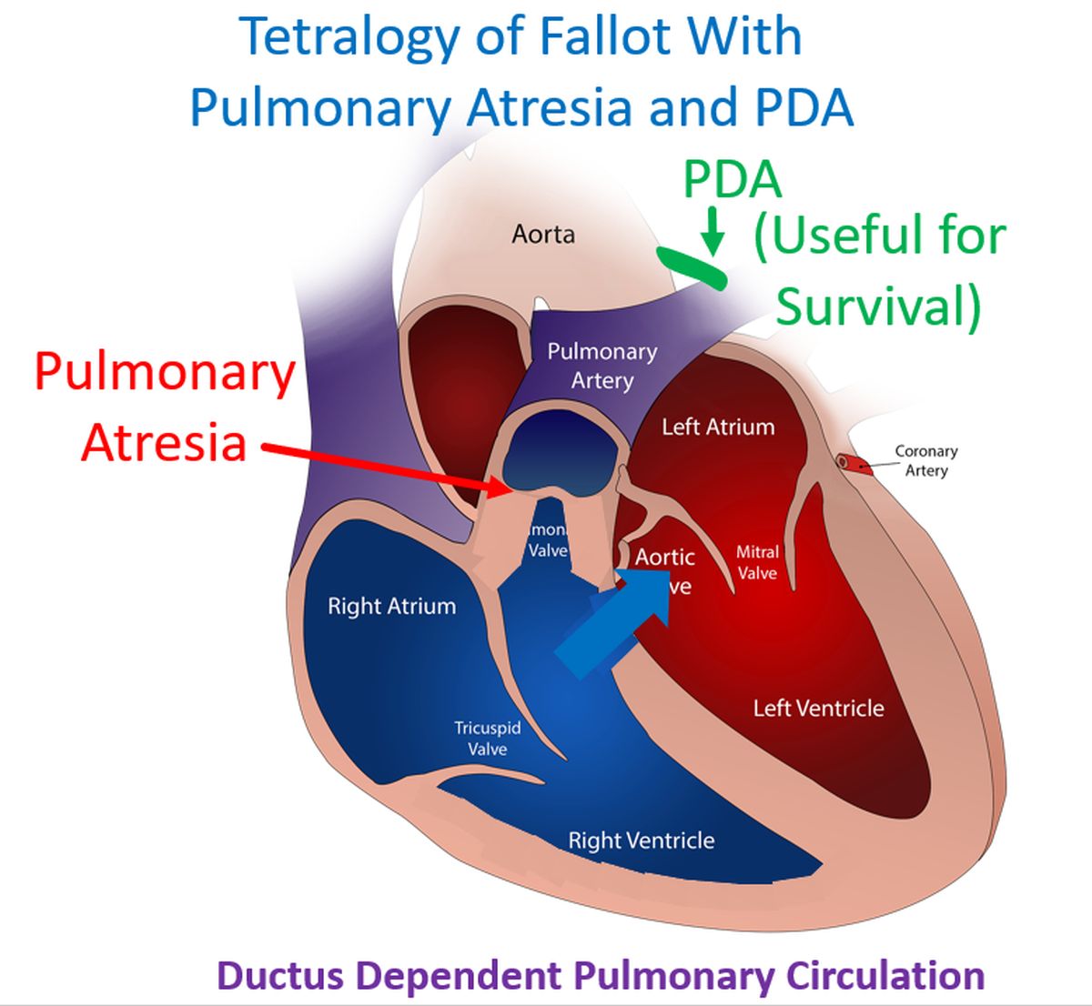 Ductus Dependent Pulmonary Circulation