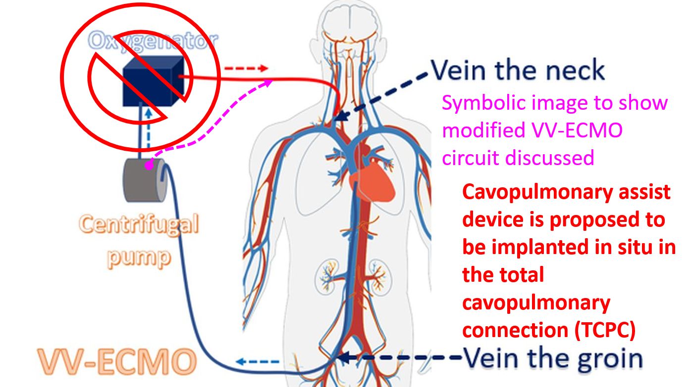 Symbolic image to show modified VV-ECMO circuit discussed